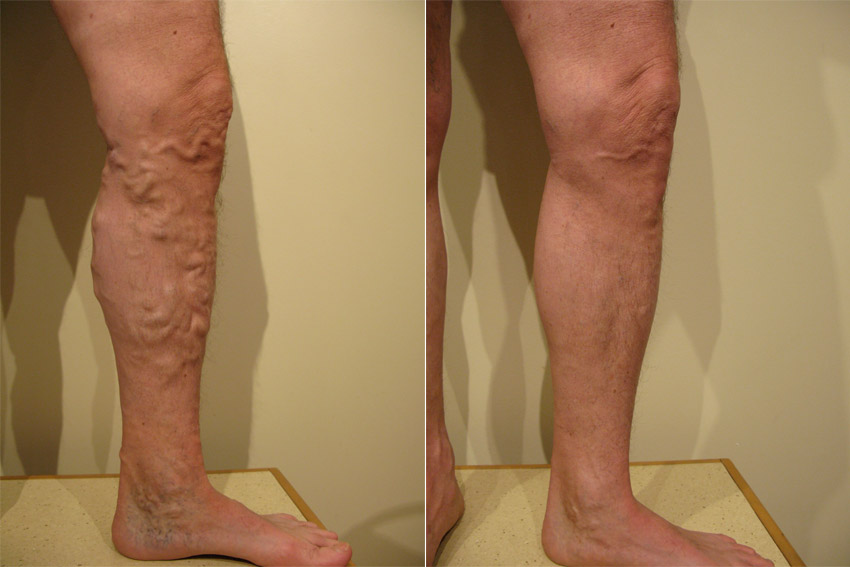 Krampfadern Mit Laser Behandeln Vorher Nachher Dermatologie Hanau